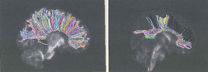 Two brain scans side by side: the left image shows a brain with multicolored neural pathways in an arc-pattern. The right image, significant for Traumatic Brain Injury diagnosis, displays similar pathways in horizontal layers, both set against a dark background.