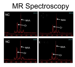 Image showing four MR Spectroscopy graphs labeled NC, crucial for Traumatic Brain Injury Diagnosis. The graphs display spectral lines with labeled peaks for N-acetylaspartate (NAA) and Creatine (Cr) in each plot.