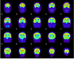 A grid of 24 brain scan images offers a comprehensive view for Traumatic Brain Injury diagnosis. The scans reveal color variations—blue, green, yellow, and red—highlighting different activity or density levels across various cross-sections and angles.