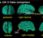 Comparison image of four 3D brain scans labeled as 