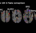 Brain MRI scan comparison reveals multiple sections labeled: PFC, DLPFC, SFG, and Temporal. Colorful highlights pinpoint areas of interest on gray brain slices against a black background, aiding in the Traumatic Brain Injury diagnosis process.