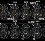 Medical brain scans display various sections labeled P, Temp, SFG, DLPFC, and CC. The images are crucial for traumatic brain injury diagnosis, highlighting different regions with colorful markers indicating areas of interest or concern.