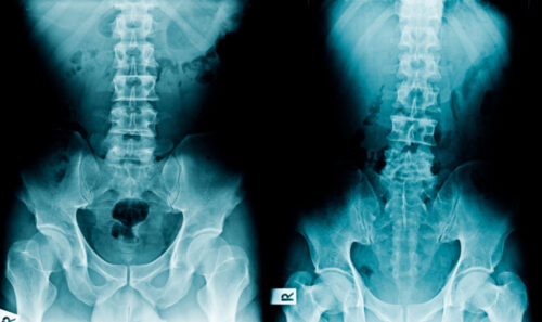 X-ray images revealing a frontal view of the lower spine and pelvis. The left image appears normal, while the right image, possibly indicative of spinal cord injury, shows abnormalities or fractures. Both images are labeled "R" for right, originating from a Connecticut medical facility.
