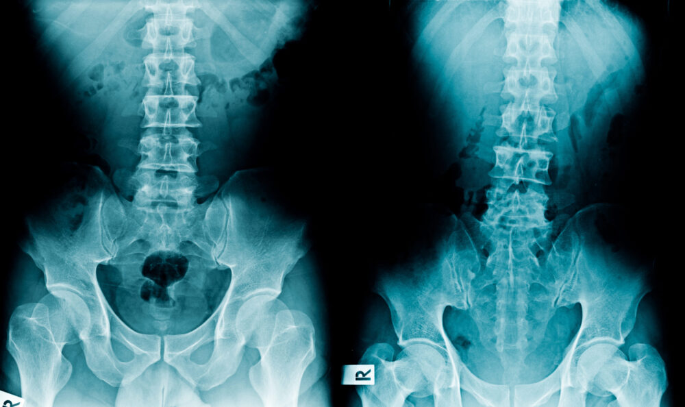 X-ray images revealing a frontal view of the lower spine and pelvis. The left image appears normal, while the right image, possibly indicative of spinal cord injury, shows abnormalities or fractures. Both images are labeled "R" for right, originating from a Connecticut medical facility.