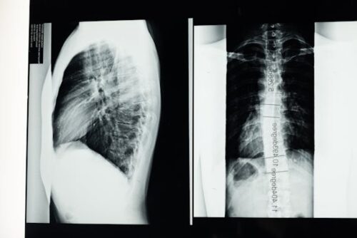 X-ray images reveal a side and frontal view of the thoracic spine, featuring a surgical rod likely indicating spinal fusion or correction. This could be related to trauma from a rear-end collision. The images focus on the chest and upper back area.